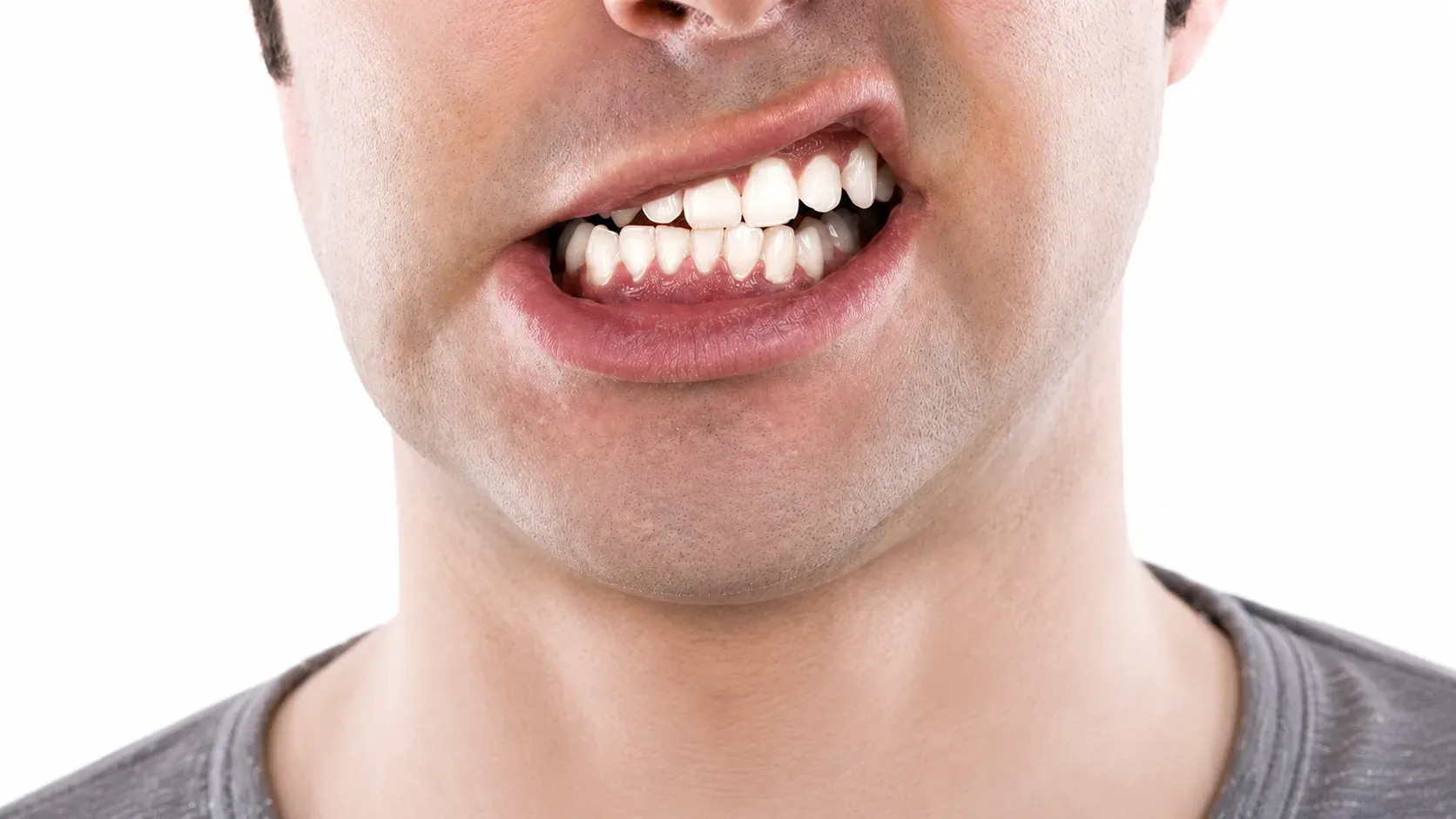 Malocclusione dentale: quando i denti non si allineano correttamente e perché è importante intervenire
